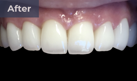 dental crowns before and after | dentist durhamn nc