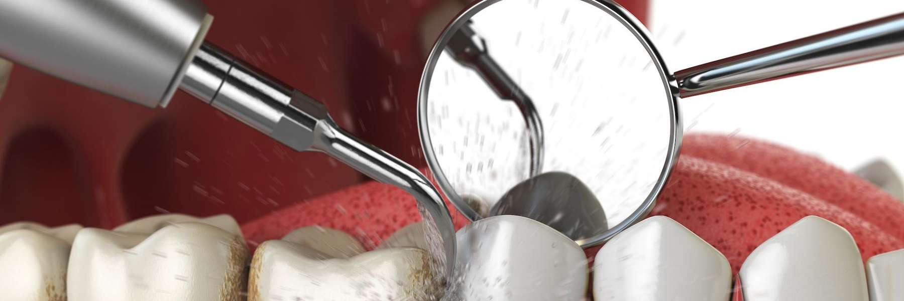 image of a teeth cleaning in durham nc