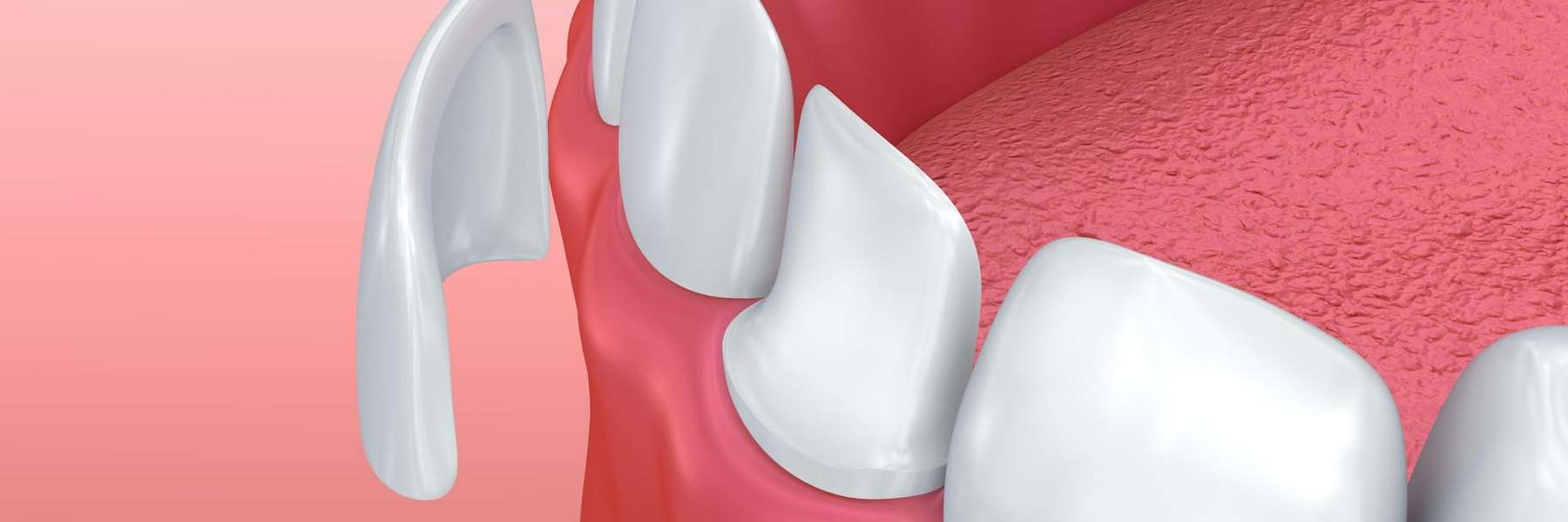 chipped tooth being covered by veneers