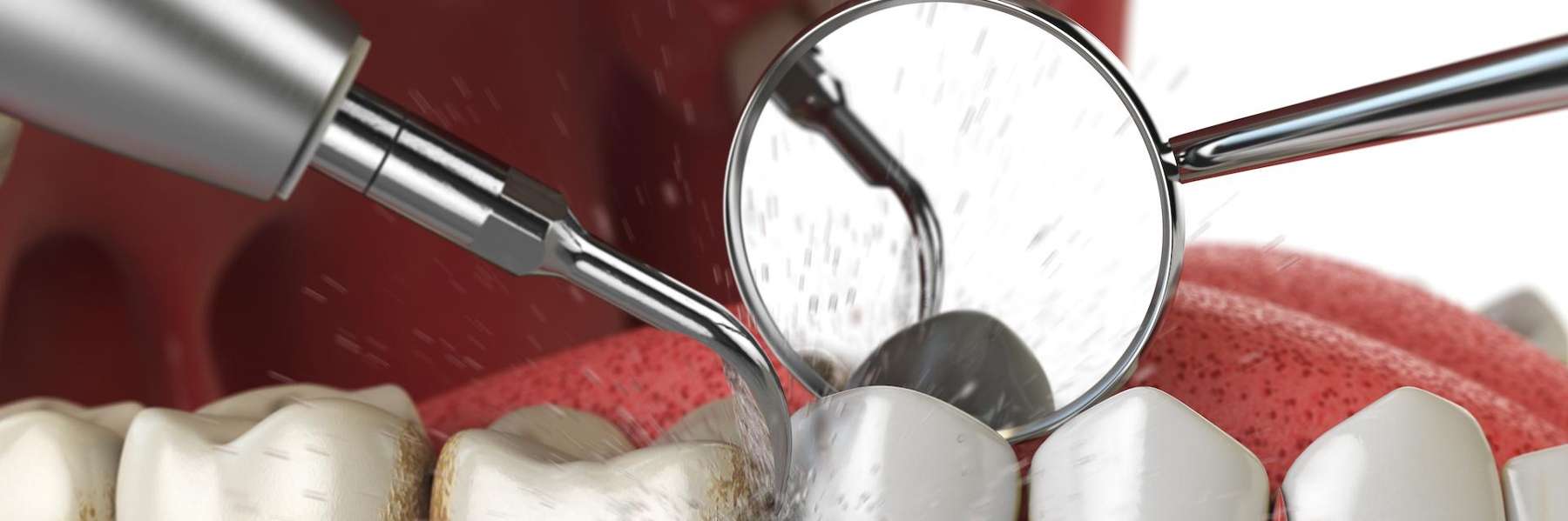 An illustration of dental cleaning in Durham, NC