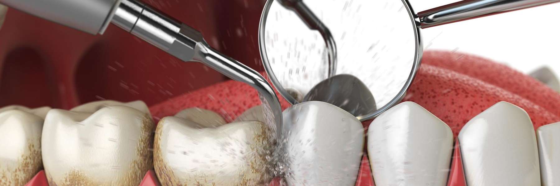 dental tools performing a dental cleaning