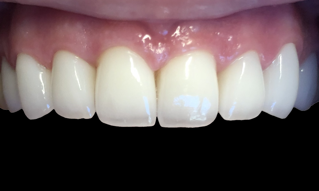 smile makeover durham nc