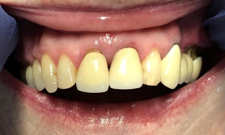 dental crowns | durham nc | the smile shop