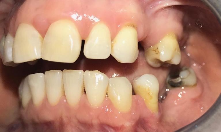 dental bridge | the smile shop | durham nc