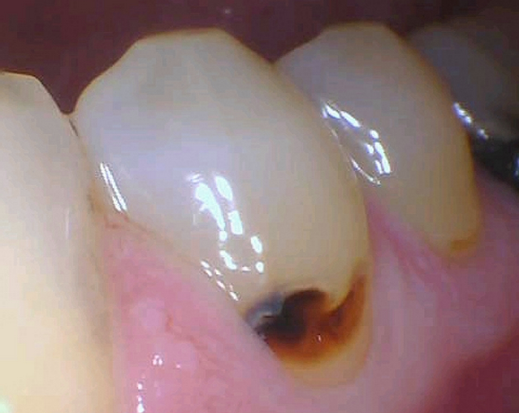 tooth-colored fillings | durham nc 