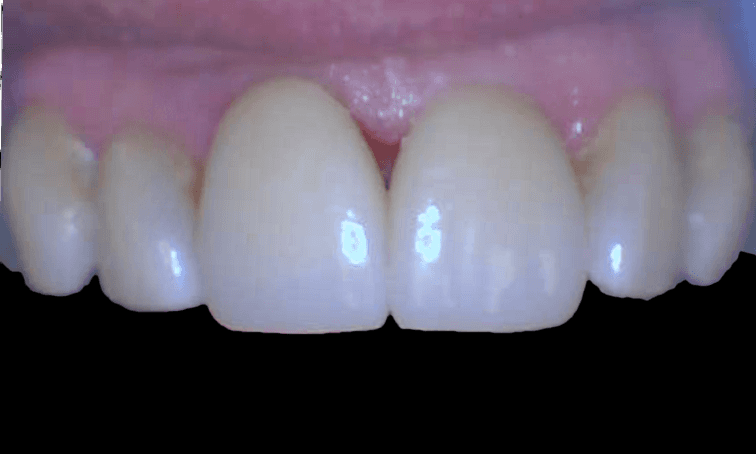 After Repairing Fractured Teeth with Crowns