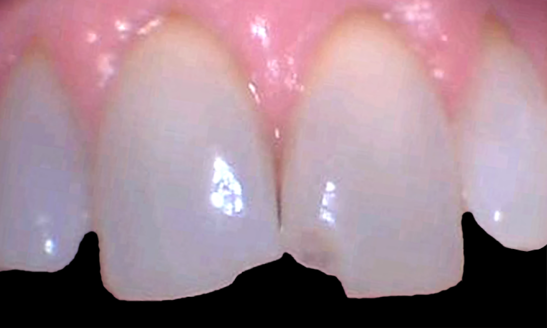 chipped tooth durham nc