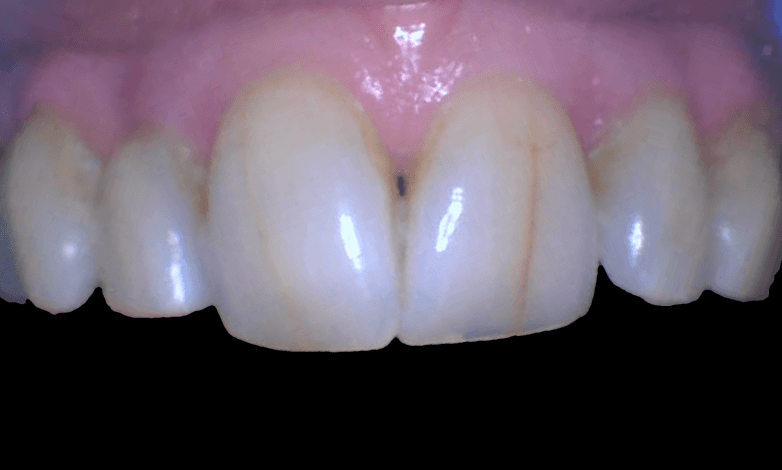 Before Repairing Fractured Teeth with Crowns