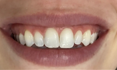 After treatment - Non Invasive White Spot Treatment
