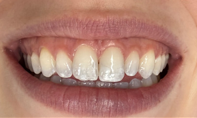 Before treatment - Non Invasive White Spot Treatment
